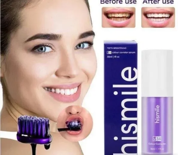 Hismile V34 Colour Corrector Teeth Whitening Serum with Before and After Results