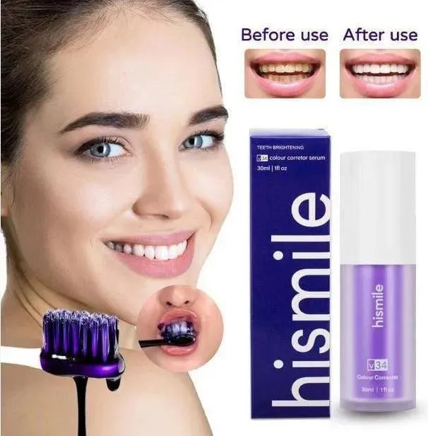 Hismile V34 Colour Corrector Teeth Whitening Serum with Before and After Results